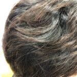 アトピー 抜け毛